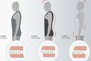 Che correlazione tra i Denti e la Postura