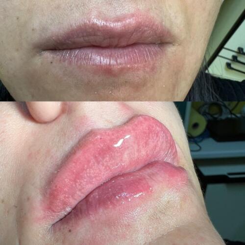 Prima e Dopo Filler labbra