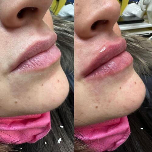 Prima e Dopo Filler labbra
